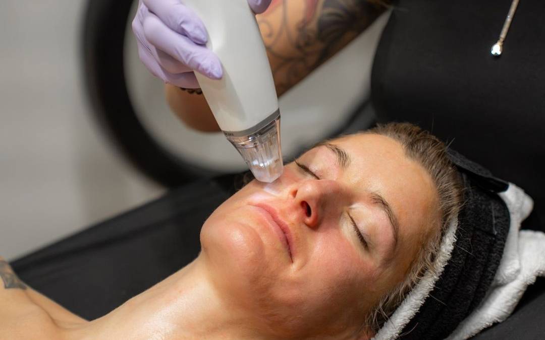 How to Choose Between Microneedling and Laser Treatments for Your Face