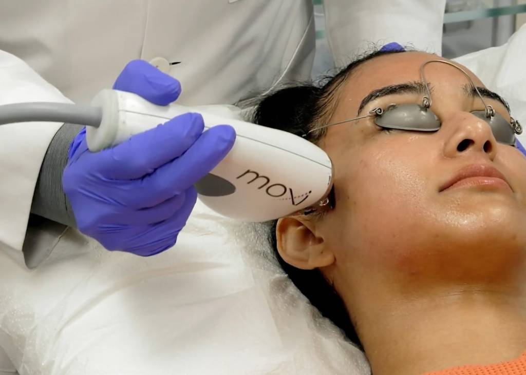 Moxi laser facial