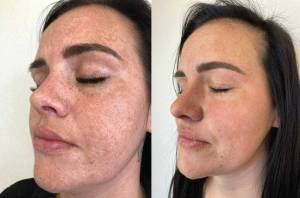 Moxi laser facial before and after Moxi laser facial before and after