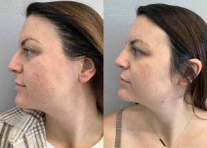 Moxi laser facial before and after Moxi laser facial before and after