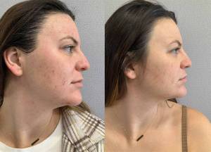 Moxi laser facial before and after Moxi laser facial before and after