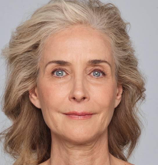 juvederm lip filler img bna cheryl before