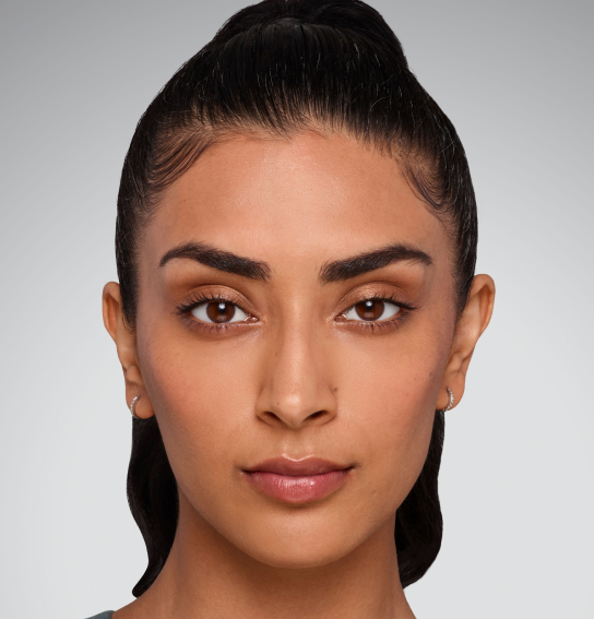 juvederm lip filler img bna jaskiran after