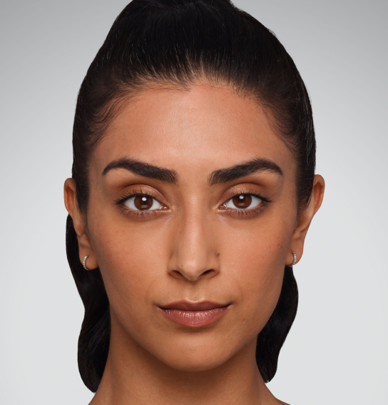 juvederm lip filler img bna jaskiran before