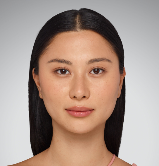 juvederm lip filler img bna sara before