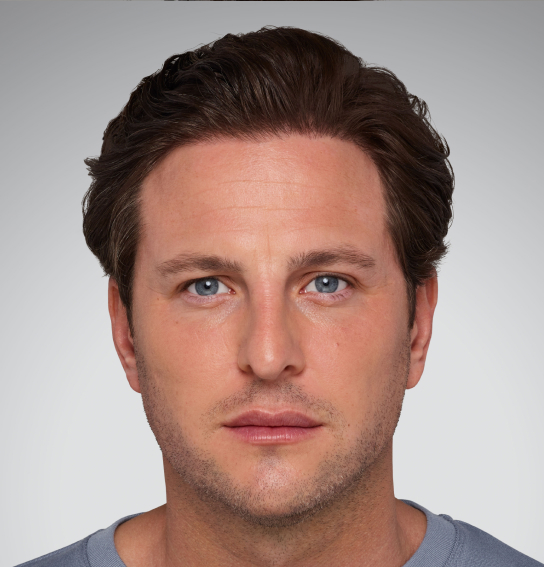 juvederm lip filler img bna terry after