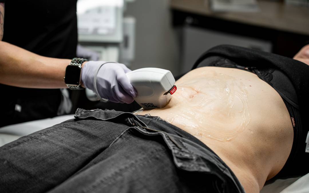 Benefits of BBL (BroadBand Light) Therapy for the Body
