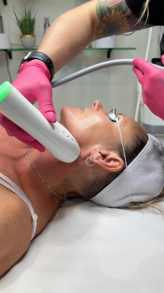 Moxi Laser Skin Resurfacing