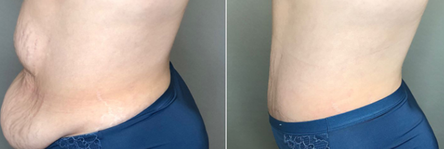 Partnering with Bend Plastic Surgery means you receive Dr. Angeles's two decades of advanced surgical expertise combined with personalized care that ensures you choose the right procedure for your unique situation, not just the most popular option.